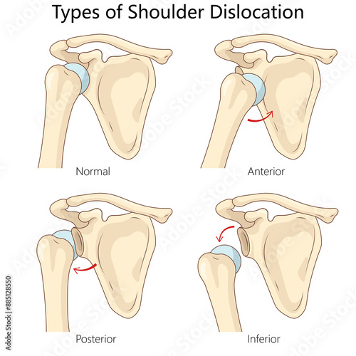 types of shoulder dislocation, normal, anterior, posterior, inferior dislocations, positions of humeral head diagram hand drawn schematic raster illustration. Medical science educational illustration