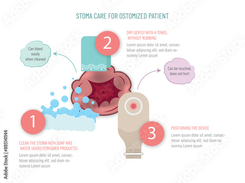 Visual guide for stoma care in ostomized patients, including cleaning, drying, and positioning of the device. photo