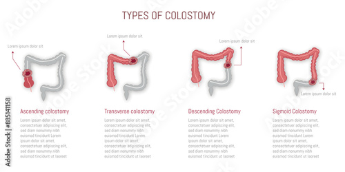 Illustration of different types of colostomy: ascending, transverse, descending, and sigmoid.