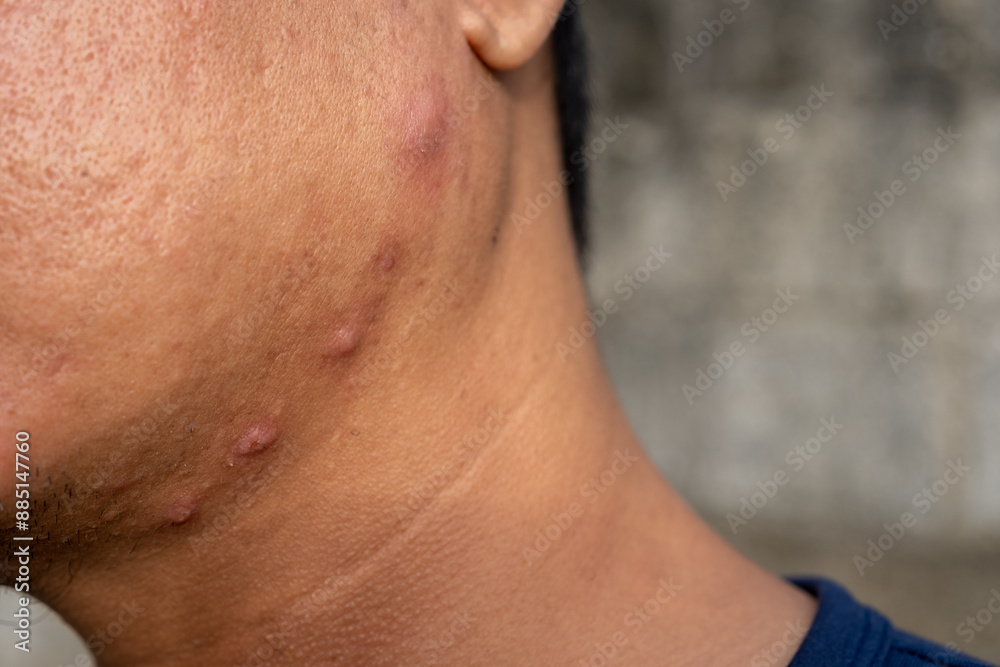 the appearance of the face, neck and cheeks full of large, festering pimples. The concept of a face lacking skin care the appearance of the face, neck and cheeks full of large, festering pimples. The concept of a face lacking skin care