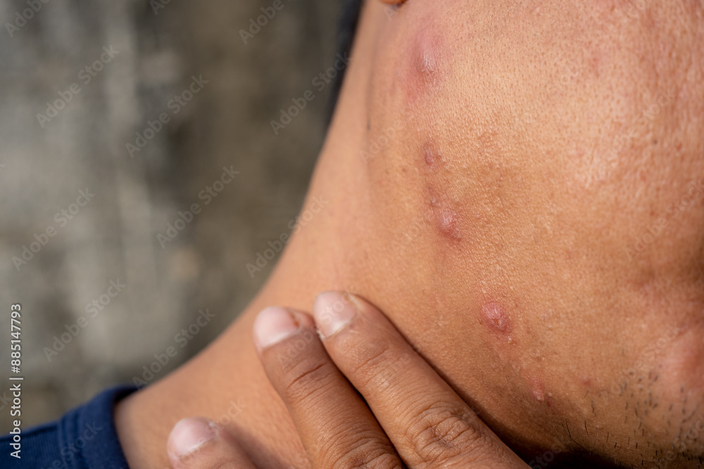 close-up of a male model showing acne growing on the neck and cheeks with a face with rough or large pores like orange peel.men's facial care concept close-up of a male model showing acne growing on the neck and cheeks with a face with rough or large pores like orange peel.men's facial care concept