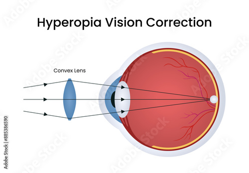 Symptoms of Hyperopia Vision Correction