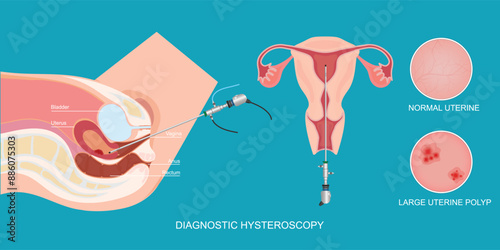 Diagnostic hysteroscopy is used to diagnose or treat problems of the uterus.