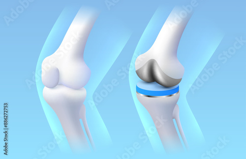 Knee implant, X-ray of the leg, 3D visualization. Vector illustration