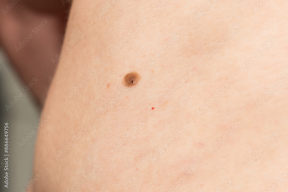 mole on the body mole on the body