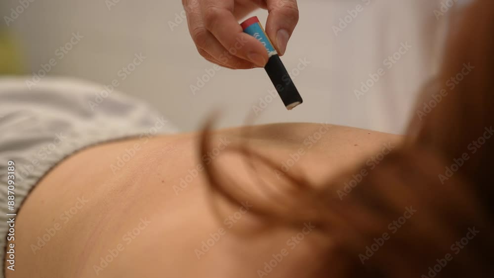 Closeup of moxa cigar held to back of female patient between acupuncture needles during healing and fertility moxibustion treatment. Healing, acupuncturist, massage therapy with physical therapy