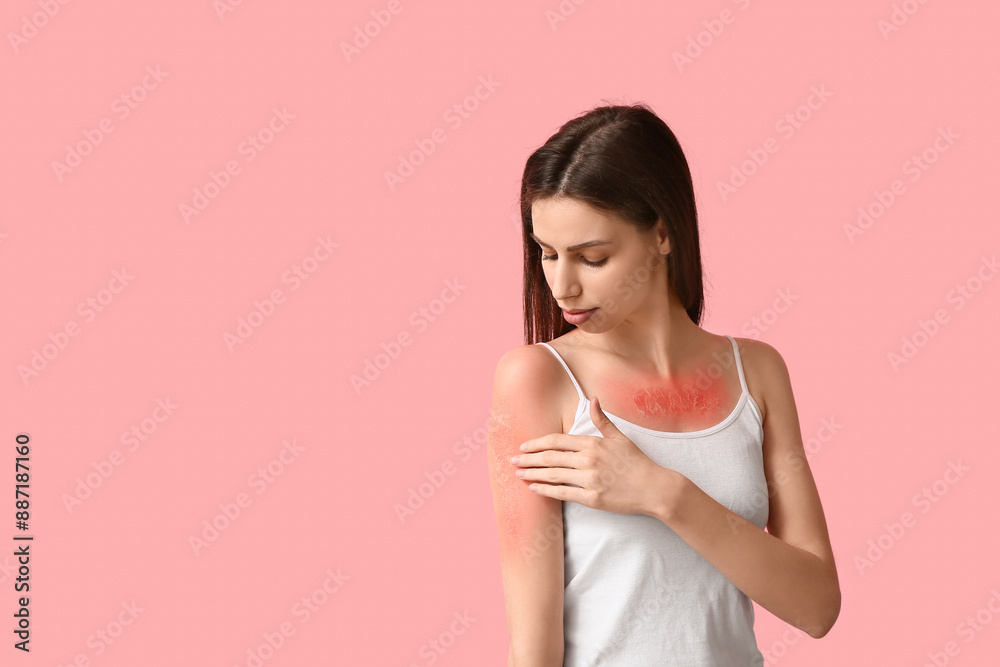 Allergic young woman with red sunburned skin on pink background Allergic young woman with red sunburned skin on pink background