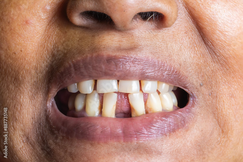 Close up of the teeth of a woman with a broken tooth.