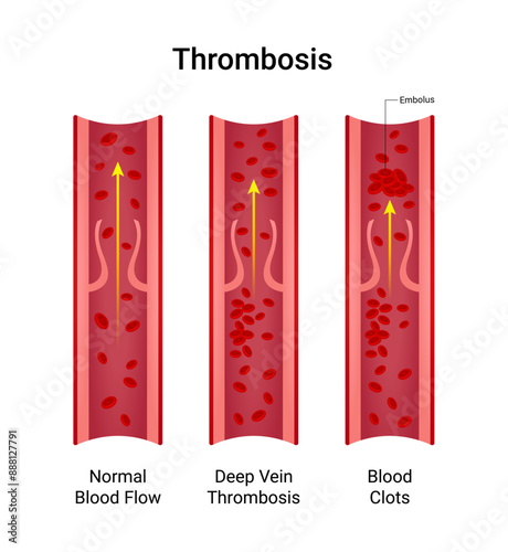 Symptoms of Deep Vein Thrombosis