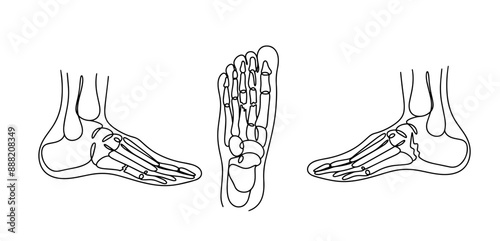 Types of Foot Fractures