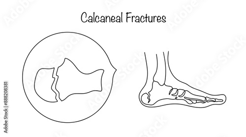 Calcaneal fractures