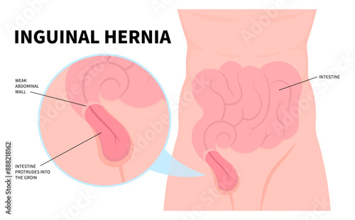 Stomach and Intestine umbilical hernia protrudes through the abdominal muscles causes pain