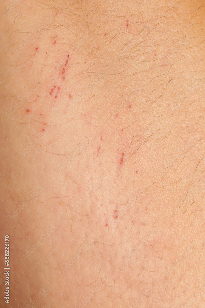 Fototapeta premium Close up view of a nasty bruise