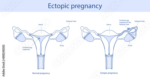 Ectopic pregnancy vector medical illustration
