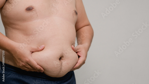 Wallpaper Mural Fat man with a big belly worries about his body. Fat man has excess fat on a white background. Concept of unhealthy body need to figure out. Men at risk for diabetes Belly fat. Obesity concept. Torontodigital.ca