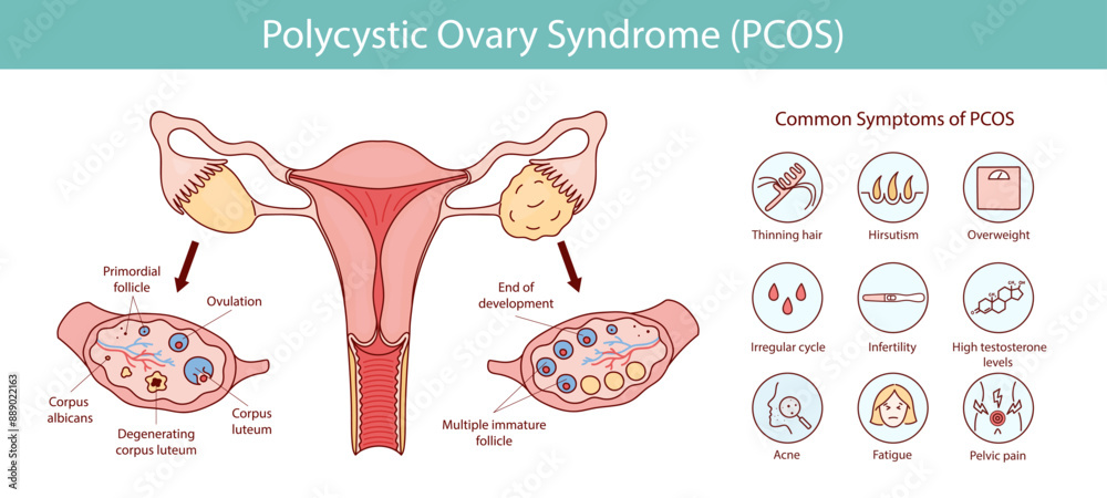 Polycystic ovary syndrome PCOS. Ovarian cysts of the female ...
