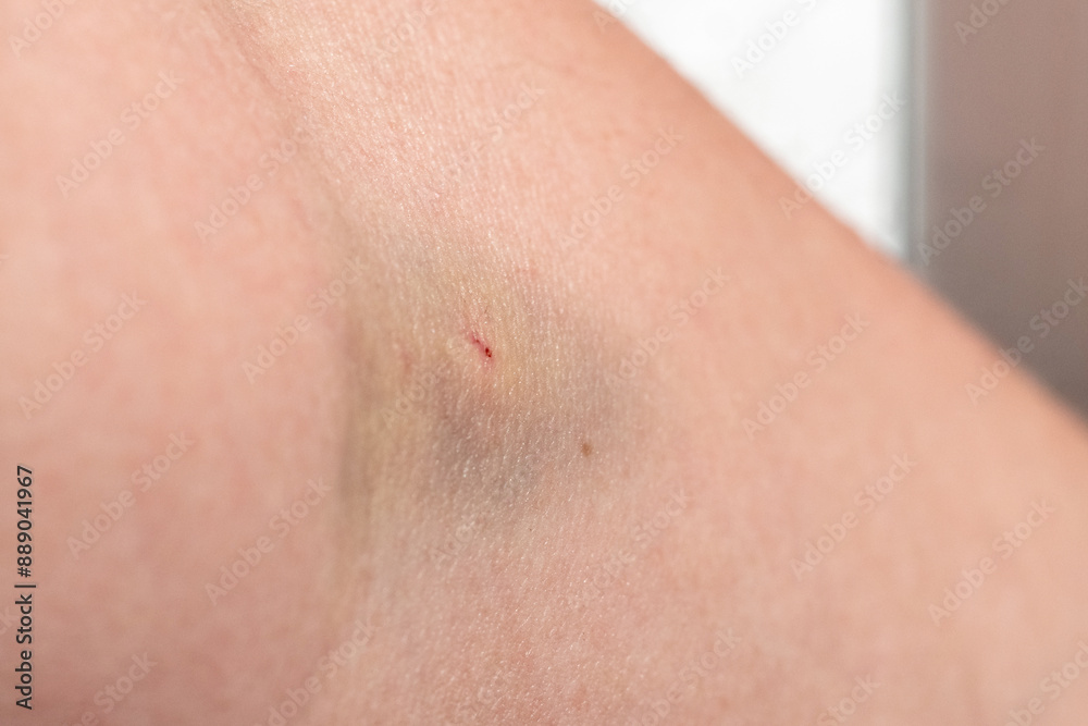 A human hand with a hematoma and traces of injections into a vein A human hand with a hematoma and traces of injections into a vein