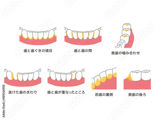 歯に溜まった歯垢　歯磨き　磨き残し