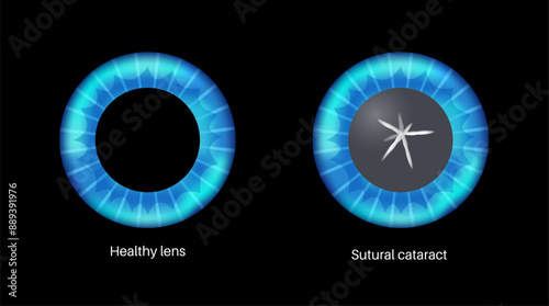 Cataract eye disease