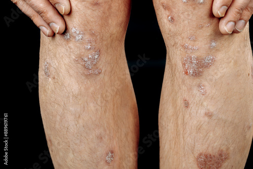 the legs of a man . psoriasis patient on a black background