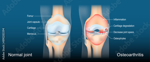 Osteoarthritis. Arthritis. Degenerative joint disease.