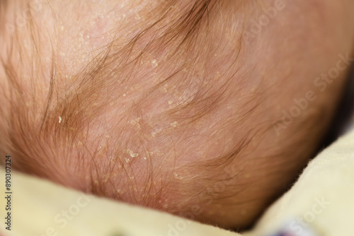 Pieces of dry skin on the head of a baby. Seborrheic dermatitis closeup photo