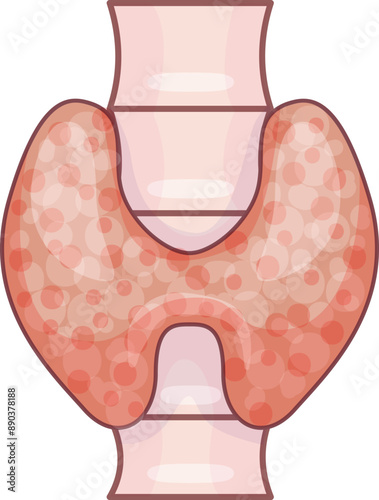 Illustration of a human thyroid gland with autoimmune disease, showing an enlarged and inflamed appearance