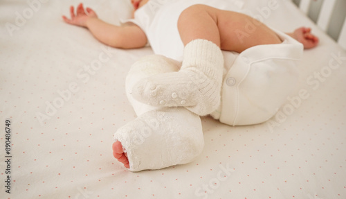 Closeup of newborn little baby with leg in a cast - clubfoot photo