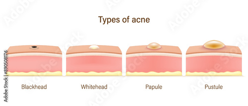 Types of acne. Human skin acne. Blackhead, Whitehead, Papule and Pustule. Vector for advertising about beauty and medical treatment. Skin problems.