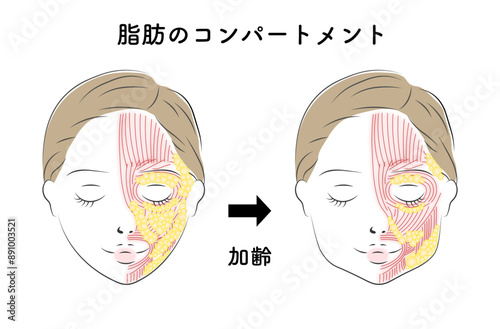 顔のたるみに悩む女性、顔の脂肪のコンパートメント_加齢変化