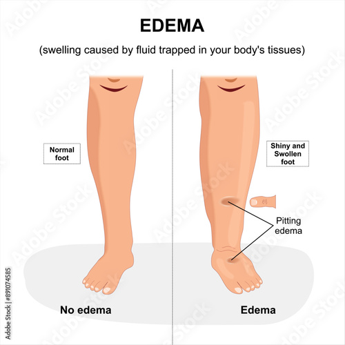 Oedema swollen leg illustration pitting edema