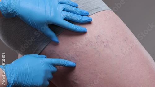 Removal of varicose veins on the legs. Medical inspection and treatment of Telangiectasia. Phlebeurysm.sclerotherapy