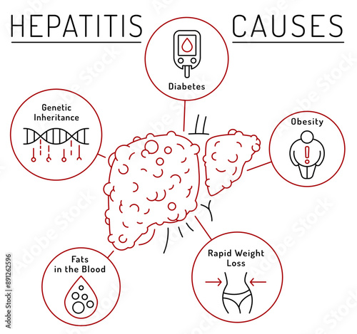 Causes of hepatitis. Hep precaution. Vector illustration