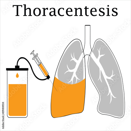 Thoracentesis Procedure Medical Poster - Chest Wall Incision, Fluid Removal from Compressed Lung