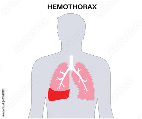 Hemothorax Medical Illustration - Blood Accumulation in the Lung, Respiratory System Disease Diagram