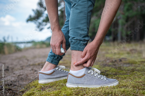 Fotografie Man with mosquitoes bites, itching leg, applying treatment ointment on swell skin, suffering from allergic reaction