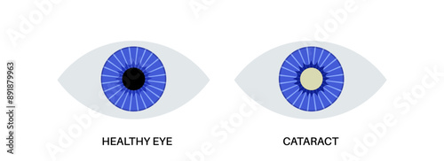 Cataract eye disease