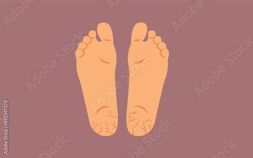Feet with Cracked Heels Vector Conceptual Illustration. Damaged skin on barefoot person medical drawing 
