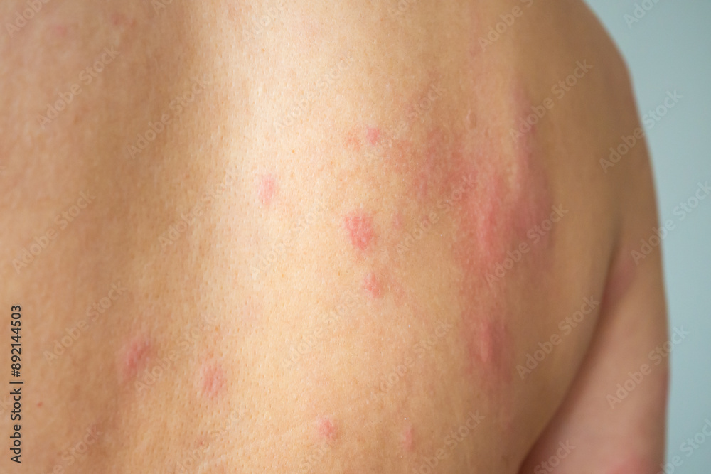 Young asian man itching and scratching on his back from allergic itchy dry skin eczema dermatitis insect bites Young asian man itching and scratching on his back from allergic itchy dry skin eczema dermatitis insect bites