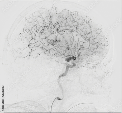 Cerebral angiography is a specialized procedure to visualize the arteries and veins in the brain for medical diagnosis. photo