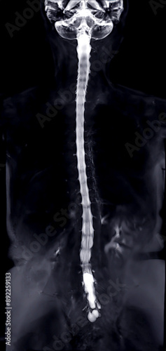 MRI of the whole spine reveals detailed images of the spinal cord for comprehensive evaluation. photo