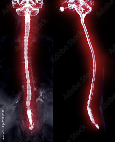 MRI of the whole spine reveals detailed images of the spinal cord for comprehensive evaluation. photo