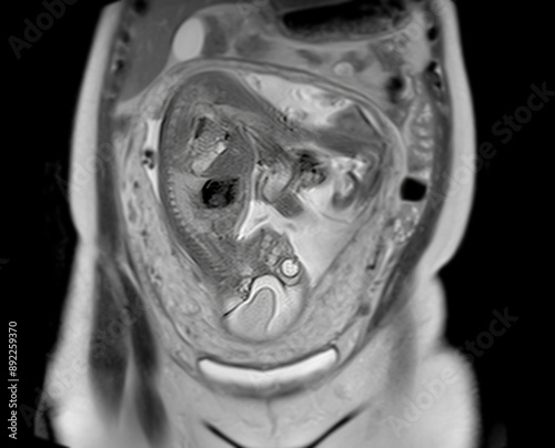 MRI during pregnancy ensures non-invasive evaluation of fetal health.