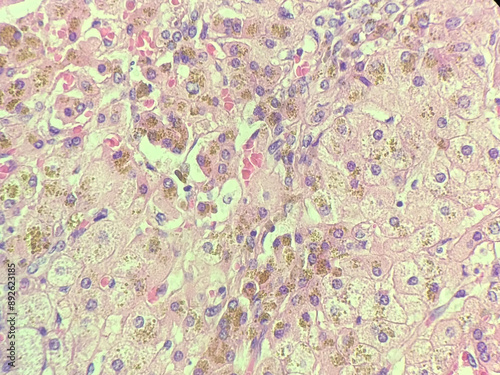 Hemosiderin deposits in liver biopsy. photo