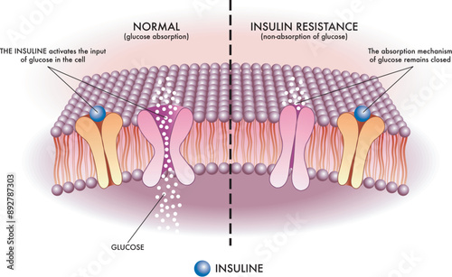 Medical illustration shows in a simple and schematic way the mechanism of insulin resistance, one of the causes of type 2 diabetes.