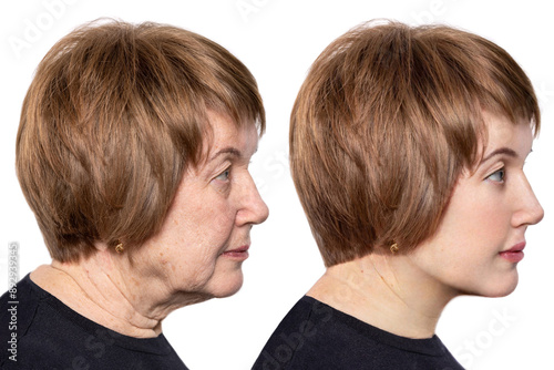 Portraits of an elderly woman before and after facelift and various cosmetic procedures.