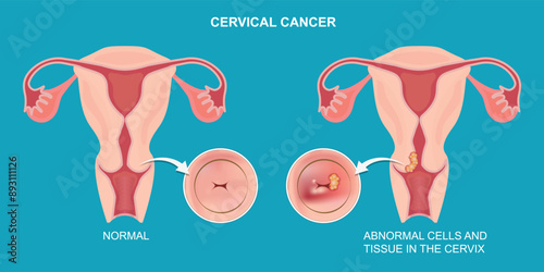 Cervical cancer is a growth of cells that starts in the cervix.