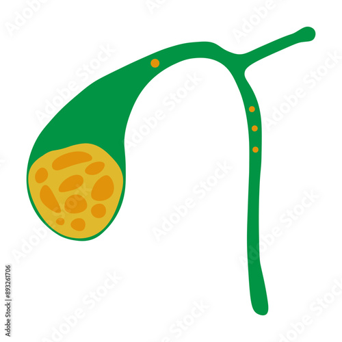 gallstones 