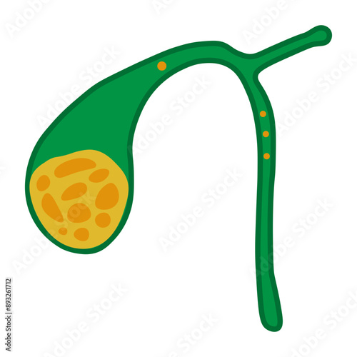gallstones