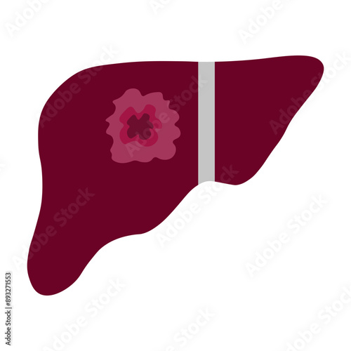 liver cancer 